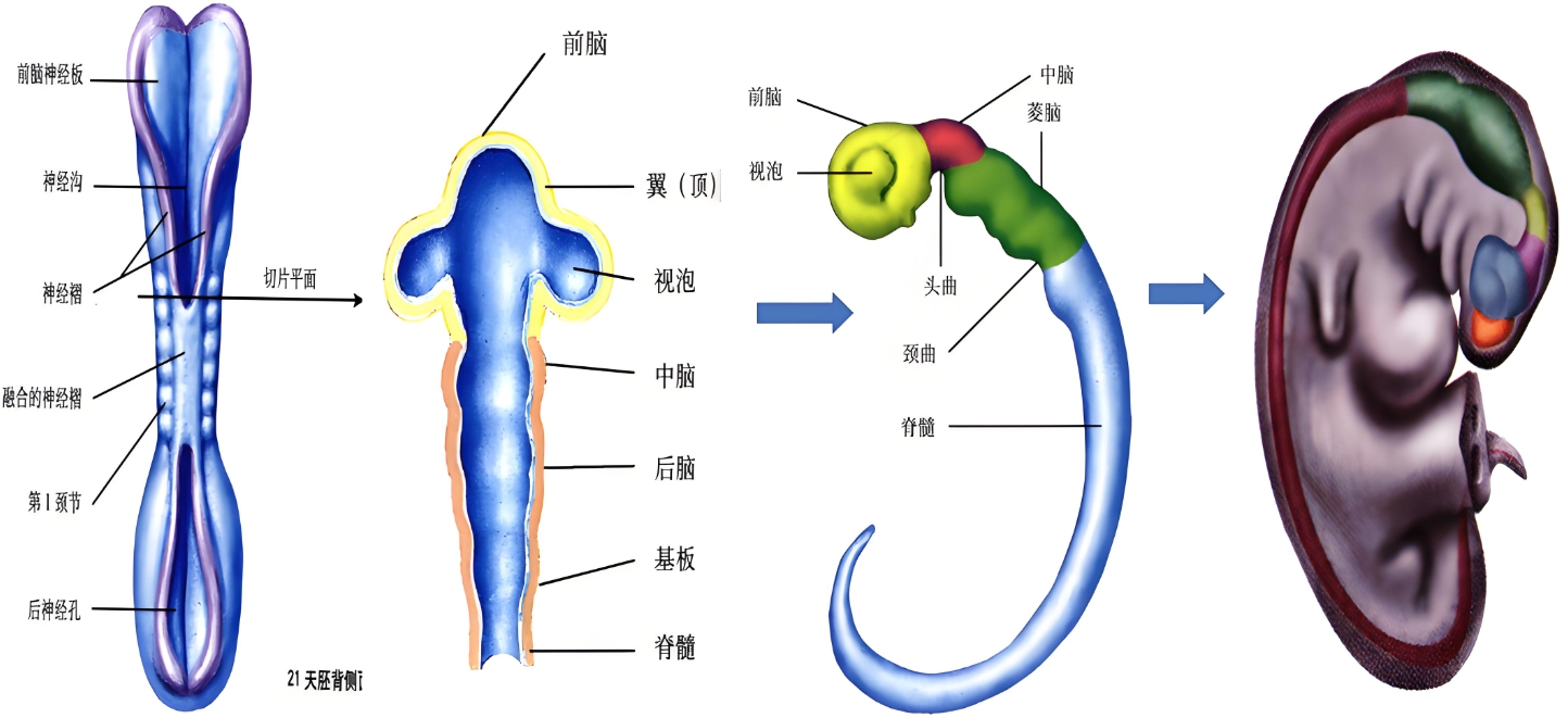 神经管畸形.png