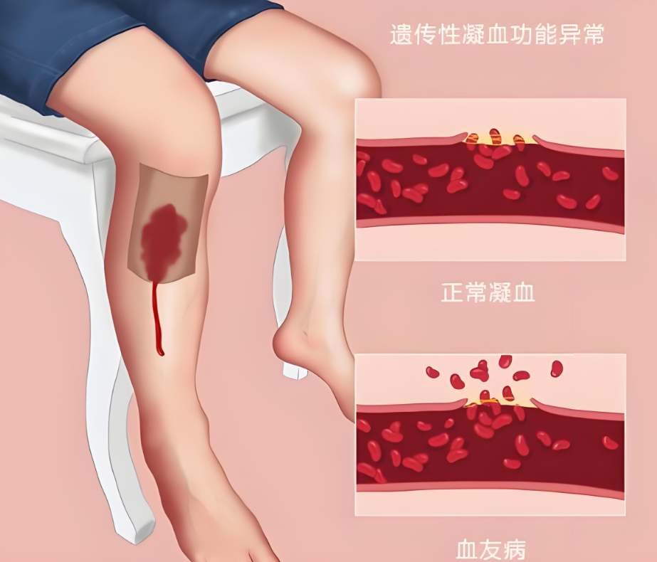 血友病