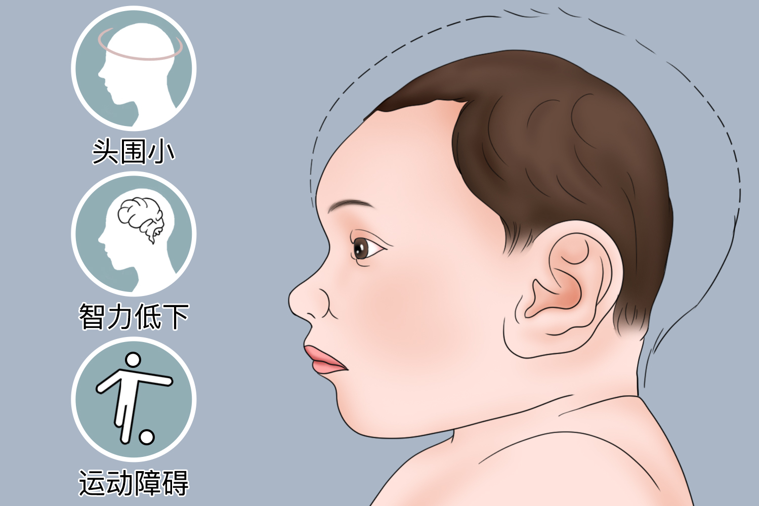Puata综合征