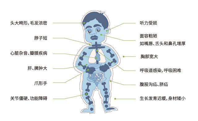 黏多糖贮积症的临床表现