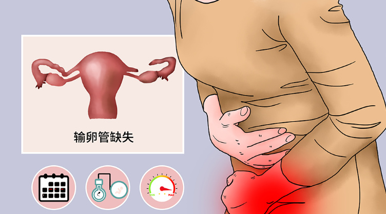 输卵管先天性发育不良