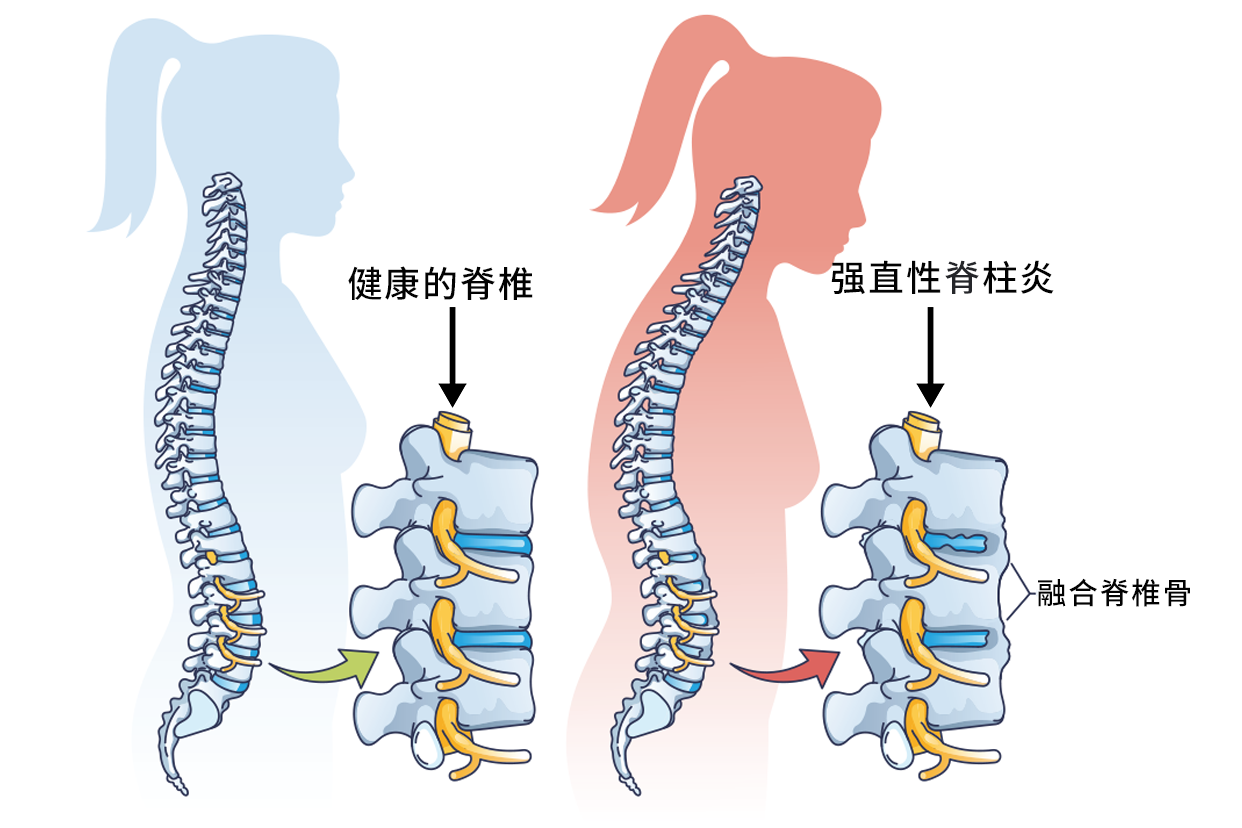 强直性脊椎炎