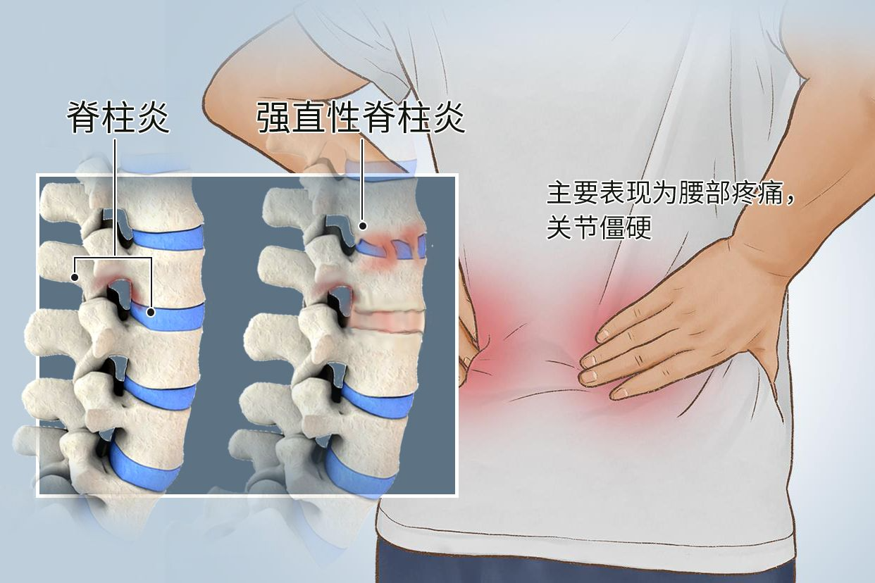 强直性脊椎炎