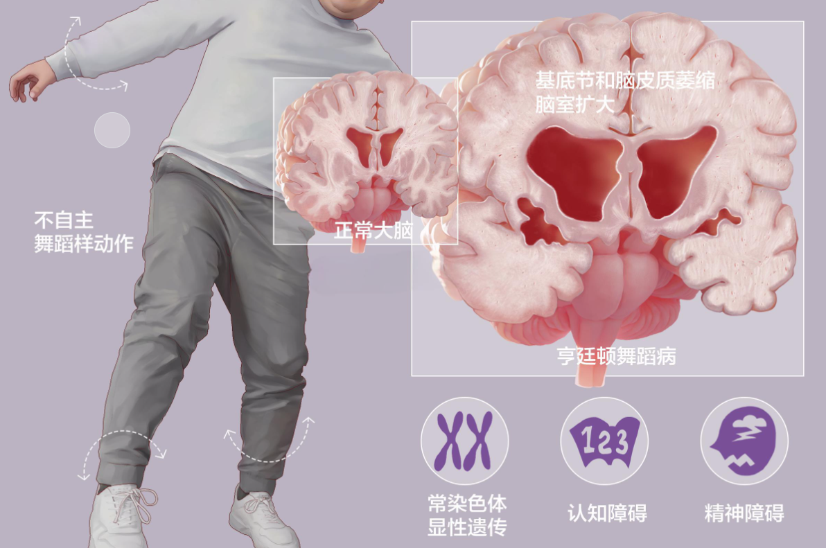 亨廷顿舞蹈症