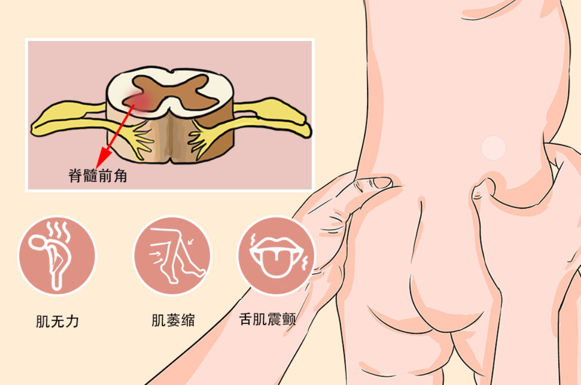 脊髓性肌萎缩症