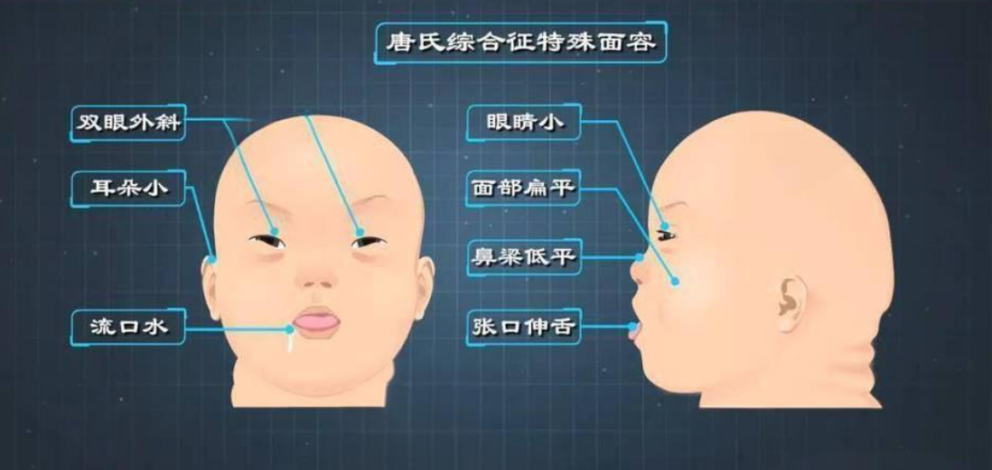 唐氏综合征表现