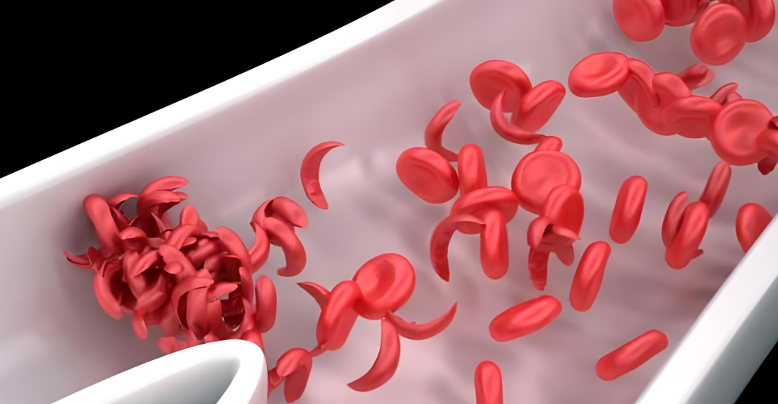 镰状细胞性贫血