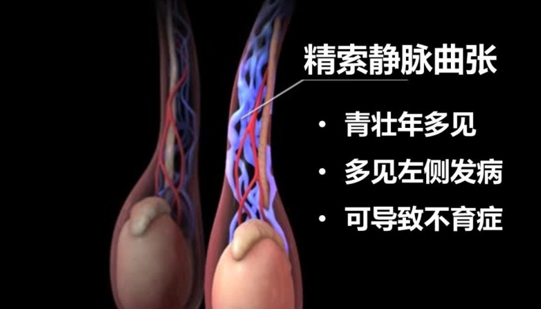 精索静脉曲张.png