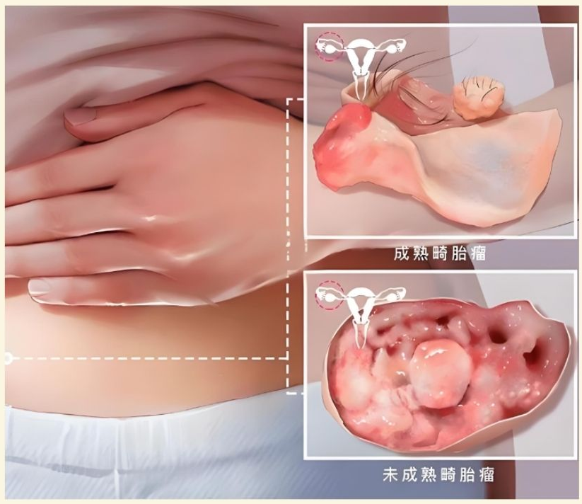 畸胎瘤