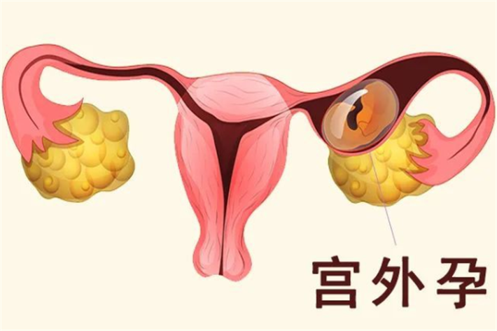 宫外孕