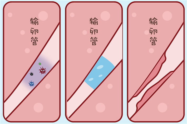 输卵管异常