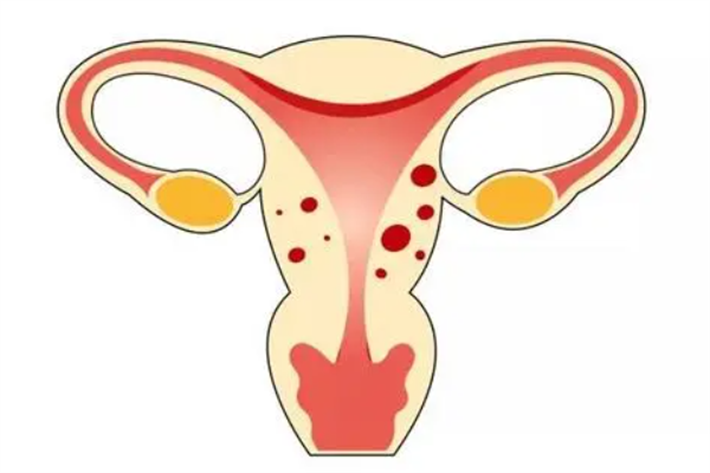 子宫内膜异位症