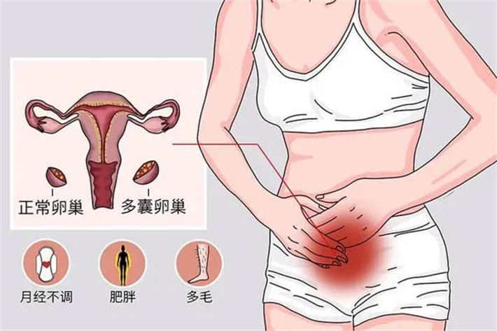 多囊卵巢