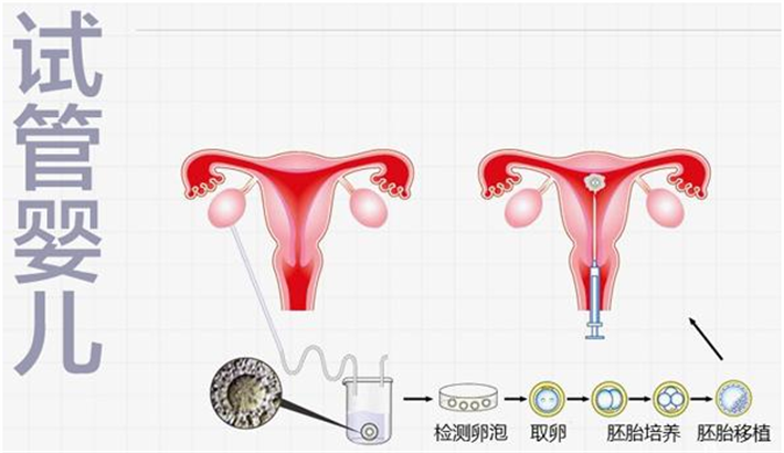 试管婴儿