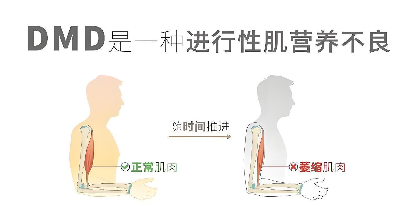 杜氏肌营养不良