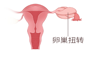 卵巢扭转