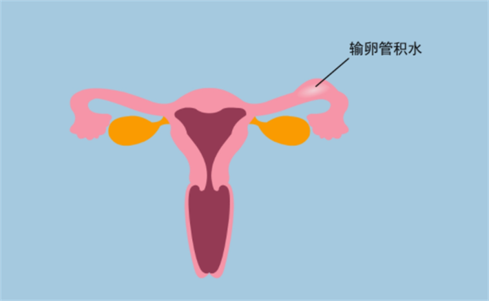 输卵管积水