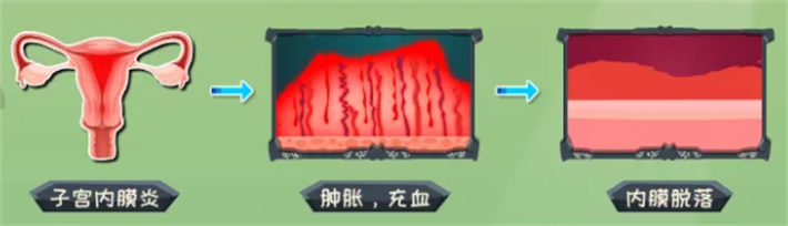 子宫内膜炎
