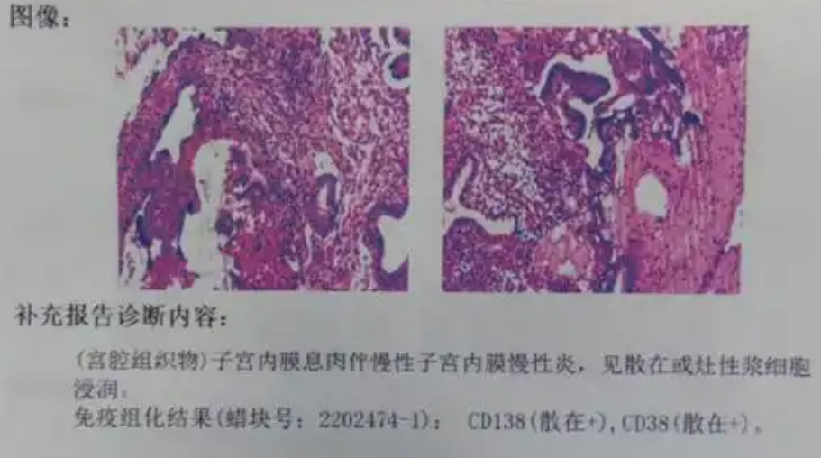 子宫内膜炎