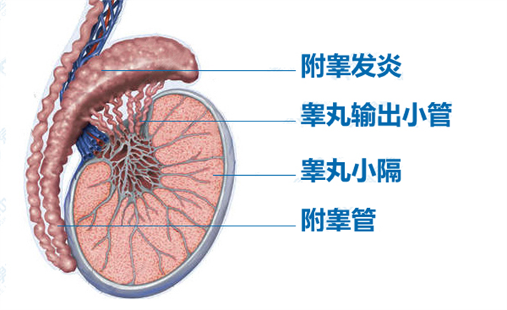 附睾炎=