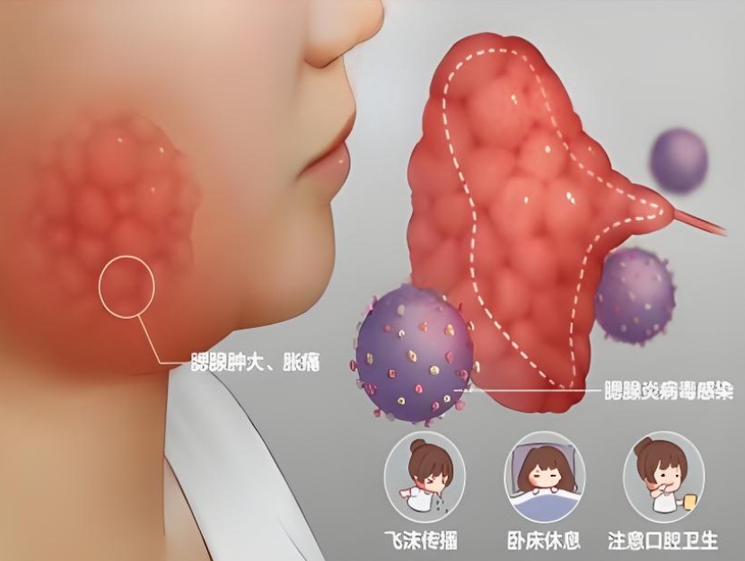 腮腺炎