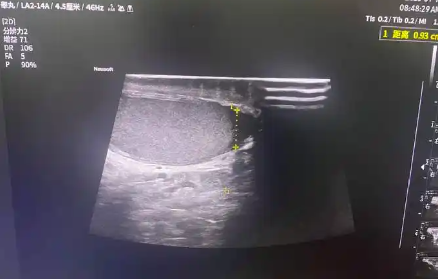 睾丸彩超影像学检查