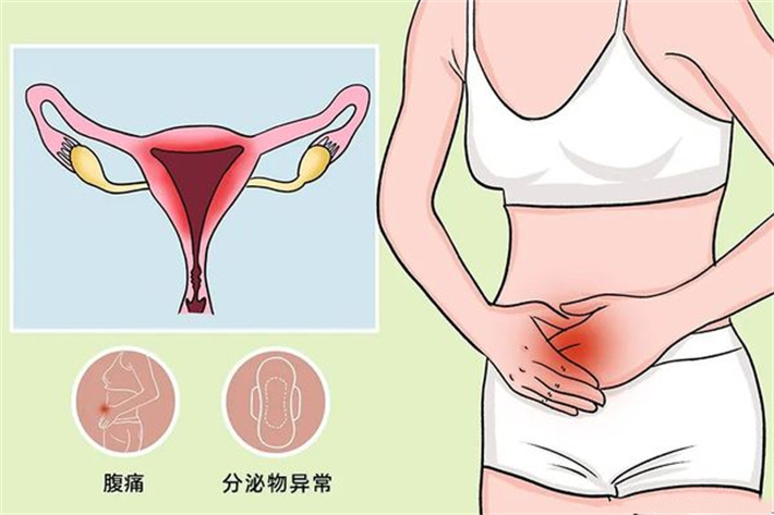 盆腔感染