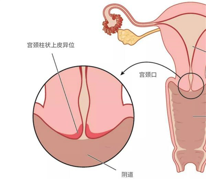 宫颈黏连