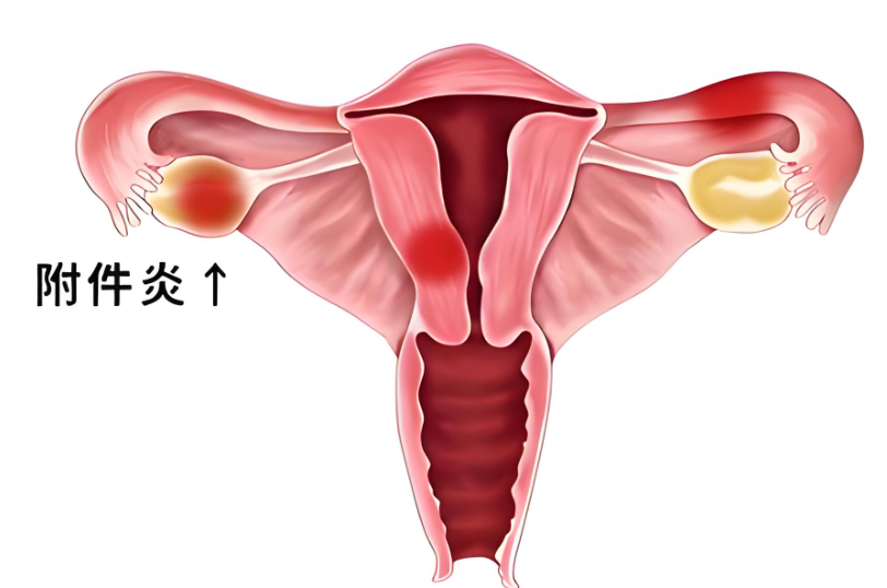 子宫附件炎