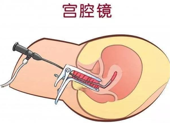 宫腔镜检查