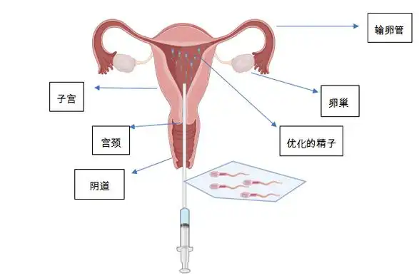 IUI人工授精
