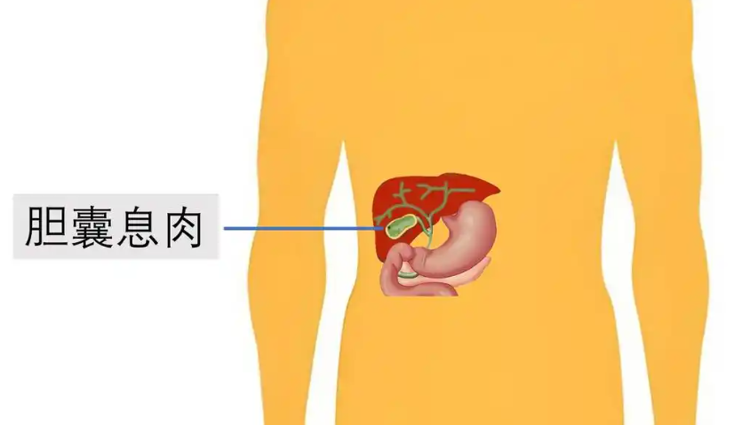 胆囊息肉