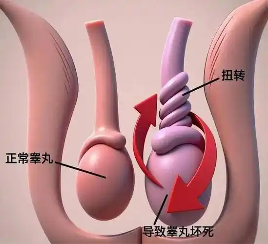 睾丸扭转