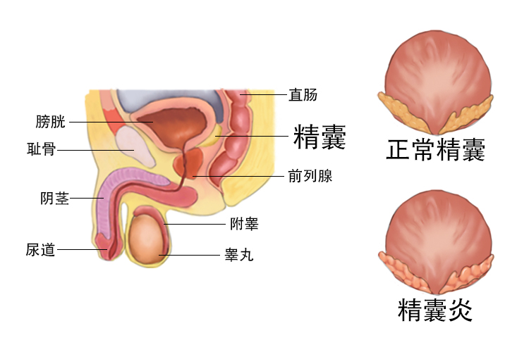 精囊炎