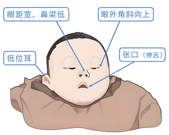 唐氏综合征的表现