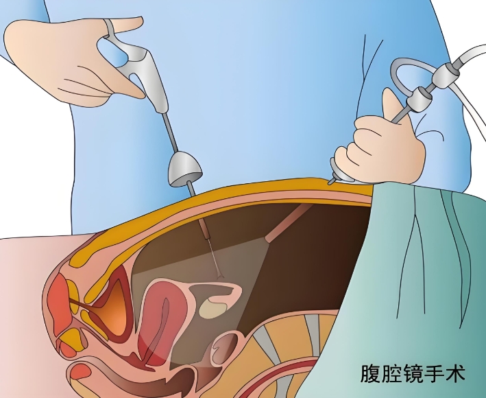 腹腔镜手术.png